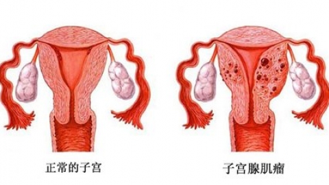 引产、刮宫可致子宫「永久损伤」，专家解答可能的预防办法