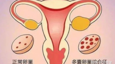 多囊卵巢综合征