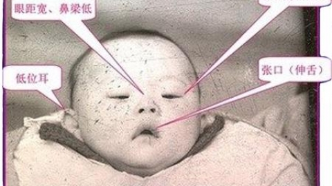 这7类夫妇最易生“唐氏综合症”儿