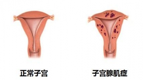 子宫腺肌症和子宫腺肌瘤的区别有哪些