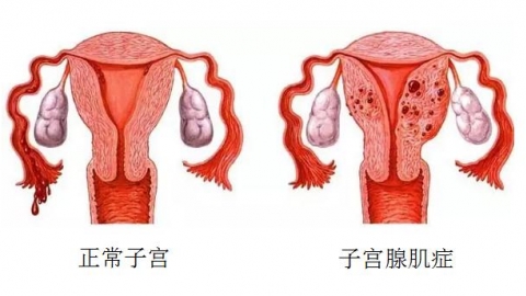 女性痛经警惕子宫腺肌症 子宫腺肌症的表现竟这么多
