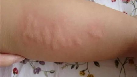 如何判断是否幼儿急疹 这6个特征全中是急疹无疑