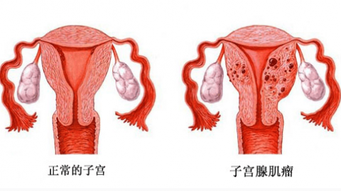 子宫腺肌症新的治疗方法！