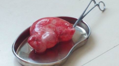 巧克力囊肿一般在什么情况下会破裂或卵巢囊肿蒂扭转？？
