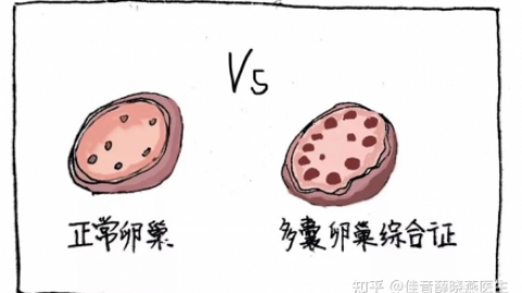 03  多囊卵巢综合征的临床症状