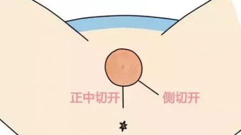 生孩子如何避免会阴侧切？
