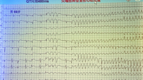 西酞普兰致QT间期延长并尖端扭转型室速一例