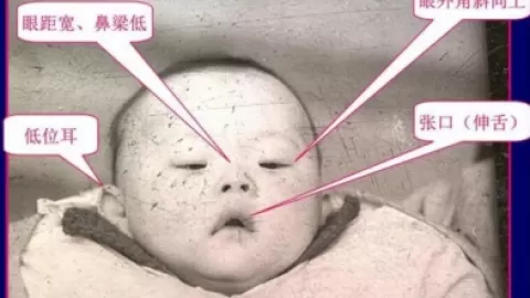 唐氏综合症，准妈妈应该知道的疾病！