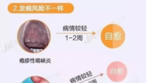 春季疱疹性咽峡炎高发期！比手足口病还厉害！