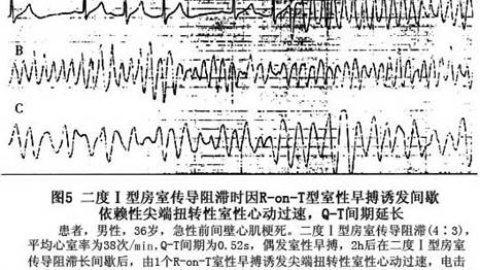 获得性长QT间期综合征的防治建议解读