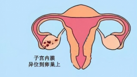 中医王黎萍：巧囊不可怕，一个痊愈案例教你认清巧克力囊肿