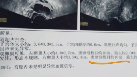 做试管婴儿前窦卵泡计数