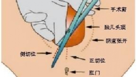 顺产侧切真的很可怕吗？侧切后的护理更重要（超详细）