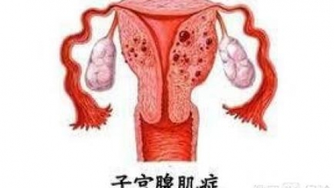 子宫腺肌症常见的并发症