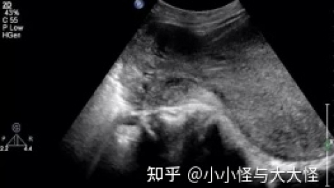 “施肥”日记：子宫内膜6mm算薄吗还会怀孕嘛