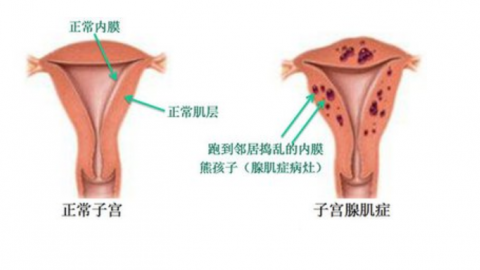 子宫肌瘤和子宫腺肌症聚焦超声消融治疗后注意事项