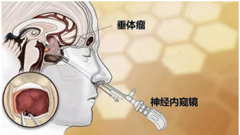 艾诺克(醋酸甲地孕酮分散片)价格