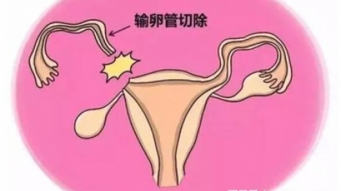 辅助生殖技术