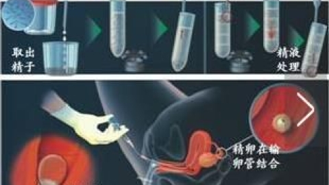 辅助生殖技术常识